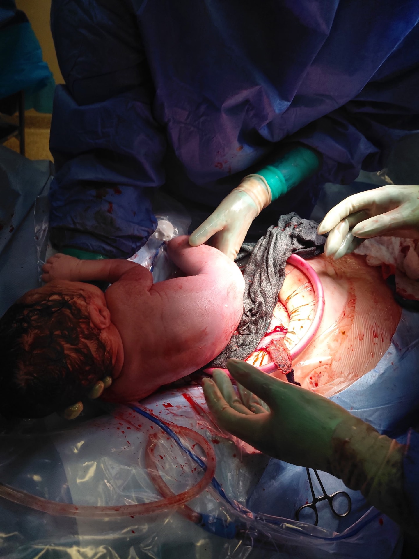 Newborn baby being delivered during a cesarean birth